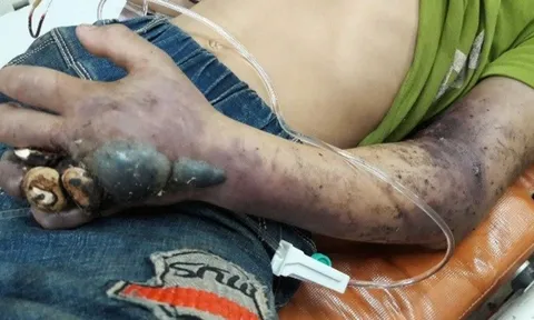 Người đàn ông rơi vào hôn mê chỉ vì hành động này sau khi bị rắn cắn, bác sĩ cảnh báo hậu quả chết người