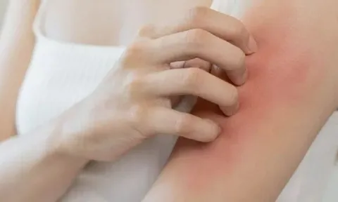 Đừng đổ lỗi cho “gan nóng” nếu bạn đang ngứa âm ỉ mỗi ngày