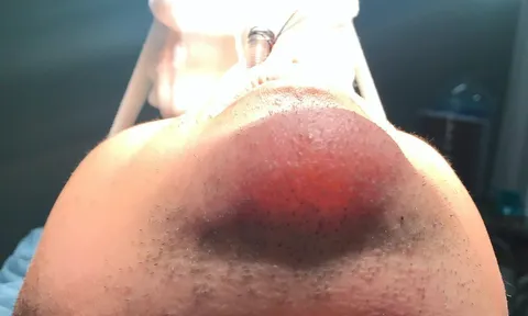 Chàng trai tá hỏa khi thấy chiếc cằm sưng tấy, "phát sáng" bất thường chỉ vì phương pháp làm đẹp này