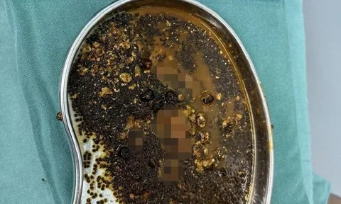 Đau bụng dai dẳng suốt 2 năm, người phụ nữ đi khám thì phát hiện hàng trăm viên sỏi trong túi mật, dày đặc đến mức bác sĩ phải thốt lên kinh ngạc