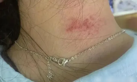 Mua vòng cổ lấp lánh giá chưa đến 700 nghìn trên livestream, người phụ nữ nhận “cái kết” viêm da phồng rộp, kiểm nghiệm phát hiện kim loại độc vượt ngưỡng sốc gấp 1.179 lần