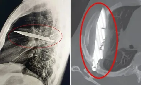 Người đàn ông sống sót kỳ diệu với lưỡi dao cắm trong ngực suốt 8 năm mà không hề hay biết