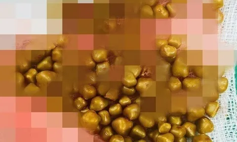 Bệnh nhân đau bụng dữ dội, bác sĩ bàng hoàng khi phải gắp ra hơn 100 viên sỏi trong túi mật