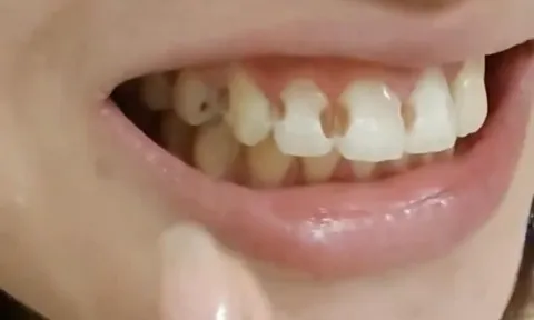 Cô gái 20 tuổi niềng răng 5 năm, tháo niềng xong khóc ngất vì phát hiện 8 chiếc răng thủng lỗ, hỏng nặng