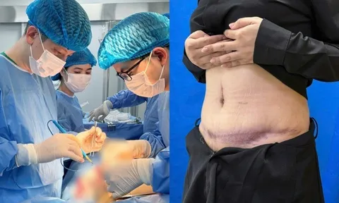 Hút mỡ, cô gái 25 tuổi bị biến dạng bụng, gây hoại tử trắng: Bác sĩ cảnh báo điều này