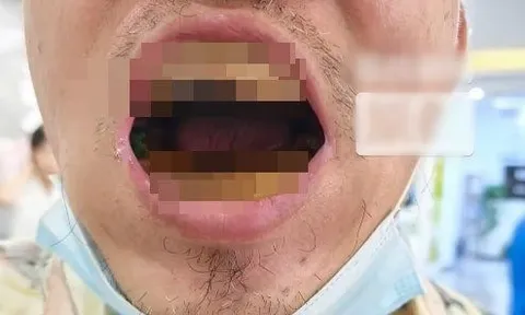 Ham tiết kiệm, người đàn ông tự làm răng giả và kết cục khiến ai nhìn cũng rùng mình