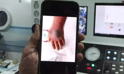 Chủ cửa hàng 60 tuổi bị cướp... cắn, suýt mất cả cánh tay vì nhiễm trùng nguy hiểm