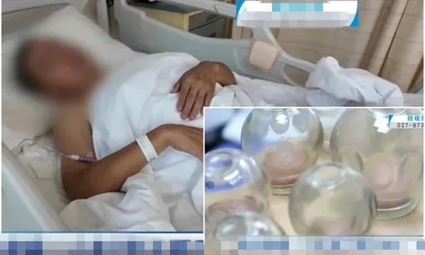 Người đàn ông liệt nửa người sau khi giác hơi tại nhà: Bác sĩ cảnh báo điều này