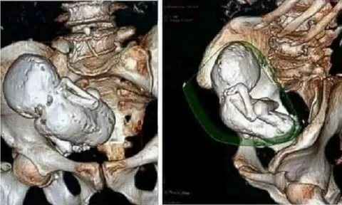 Đi khám vì đau bụng, cụ bà 73 tuổi bàng hoàng khi bác sĩ phát hiện thai nhi hóa đá suốt 30 năm