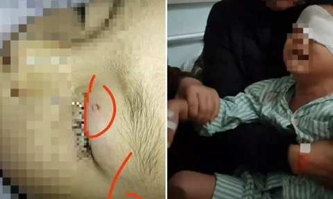 Bé trai 4 tuổi mù vĩnh viễn vì giáo viên bôi mỡ lợn lên vết thương ở mắt