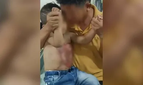 Bé trai 3 tuổi hoảng loạn gào khóc, bị bỏng nặng vì bác sĩ dùng nước sôi "chữa bệnh"