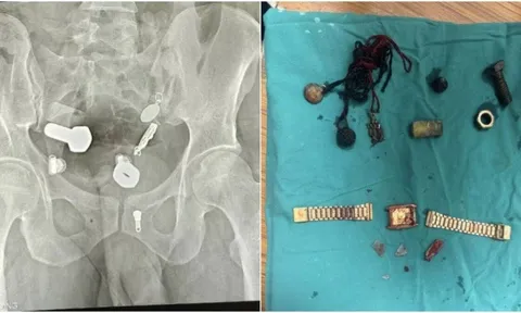 Đau bụng suốt nhiều ngày, người đàn ông bàng hoàng khi bác sĩ gắp ra... đồng hồ và nhiều dị vật khác