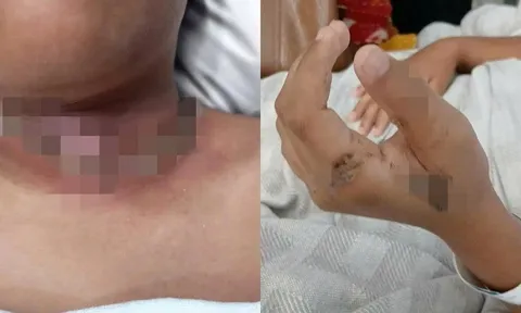 Bé trai 9 tuổi bỏng nặng vùng cổ vì thói quen sạc máy tính bảng ngay đầu giường