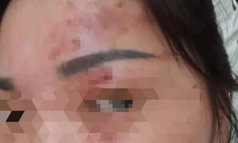 Bỏng giác mạc chỉ vì bất cẩn khi giặt đồ