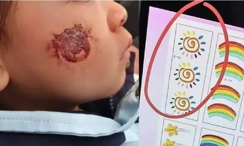 Dán sticker cho “đáng yêu hơn”, bé gái 3 tuổi nhập viện với tổn thương da nghiêm trọng, phụ huynh bàng hoàng