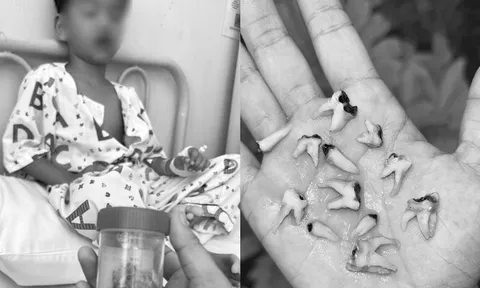 Bé trai phải nhổ 12 chiếc răng sâu cùng lúc chỉ vì thói quen này khiến nhiều cha mẹ giật mình