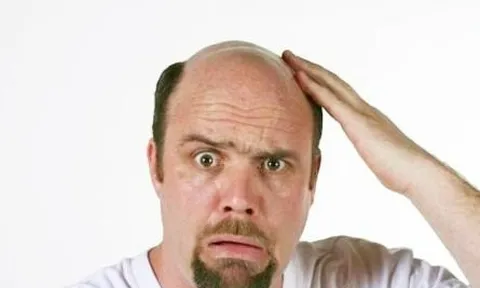 Vợ nộp đơn kiện cả nhà chồng vì... "hói đầu"