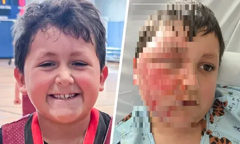 "Đu trend" Tiktok, bé trai 9 tuổi bị bỏng nặng