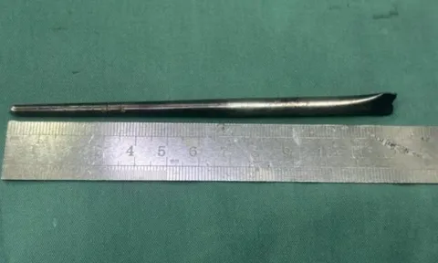 Nuốt phải đũa kim loại khi ăn, người đàn ông sống suốt 8 năm với dị vật trong cổ họng