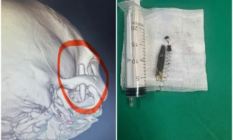 Người đàn ông mang lò xo bút bi suốt 13 năm trong vùng thái dương mà không hay biết