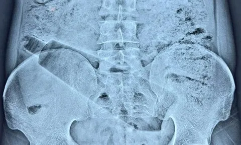 Đau bụng suốt 36 tiếng không rõ nguyên nhân, người đàn ông nhập viện và phát hiện điều khiến nhiều người bất ngờ