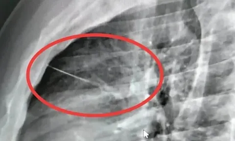 Tưởng chỉ là cơn đau ngực bình thường, người đàn ông sốc khi biết có dị vật nằm sát tim: Bác sĩ phải phẫu thuật khẩn cấp