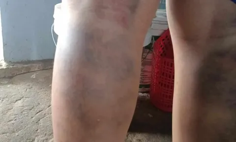 Đình chỉ công tác cô giáo đánh bầm tím chân học sinh lớp 6