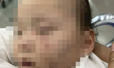 Vụ bé gái 1 tuổi có nhiều vết bầm trên mặt khi gửi ở cơ sở mầm non: Trên má có dấu hiệu vết răng cắn