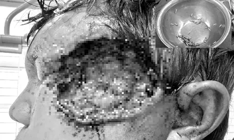 Rùng rợn: Hàng chục con dòi bò lúc nhúc trong gò má người đàn ông