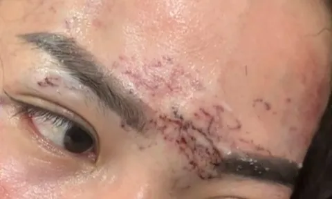 Ghen tuông kiểu “xã hội đen”: Hai phụ nữ xăm lên mặt tình địch và cái kết