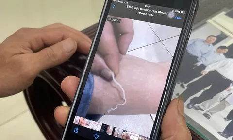 Rùng mình: Người đàn ông nặn mủ chân, kéo ra con giun dài 70cm dưới da