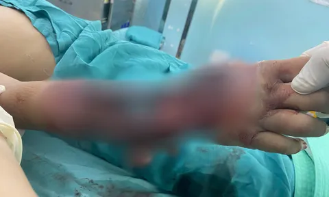 Hình ảnh kinh hoàng: Bé 10 tuổi bị tường đổ sập đè trúng, cánh tay biến dạng nghiêm trọng