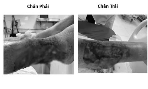 Hình ảnh lạnh gáy: Đôi chân có nguy cơ hoại tử ở bệnh nhân đái tháo đường sau chấn thương nhỏ