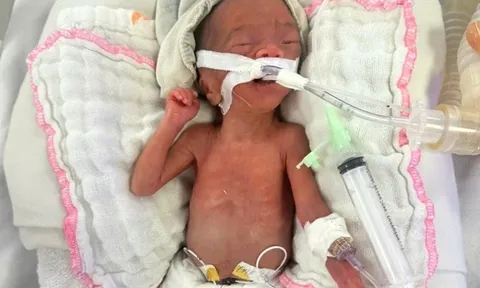 Bé gái từng nặng 550g được cứu sống thần kỳ: Hình ảnh hiện tại khiến ai cũng nghẹn ngào