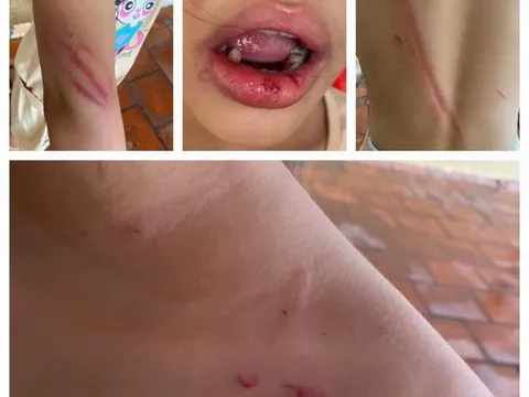 Vụ bé gái 10 tuổi bị cha dượng đánh đập ở Bình Dương: Có thể khởi tố vụ án trong trường hợp nào?