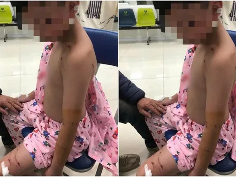 Thương tâm: Đi chúc Tết, bé trai bị chó tấn công phải khâu nhiều mũi