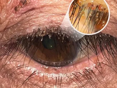 Đi khám vì ngứa mắt, phát hiện "thứ kinh hoàng" bám chi chít trên lông mi 