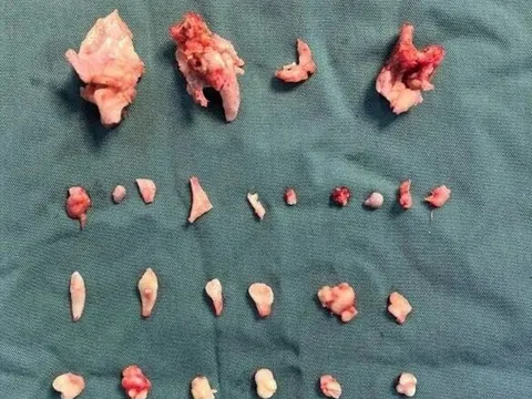 Cô gái trẻ đau bụng dưới dữ dội, kiểm tra phát hiện "thứ quái dị" bên trong