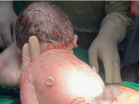 Bé sơ sinh chào đời mang “đôi cánh lạ” trên lưng