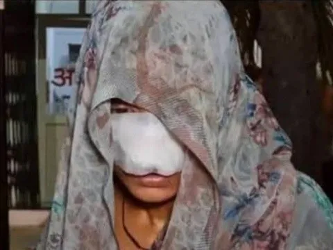 Cãi nhau, chồng cắn vào mũi và má khiến vợ phải khâu 10 mũi: Ám gương mặt biến dạng của nạn nhân