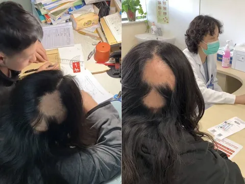 Thức đêm kèm con học, người mẹ không ngờ mình lại bị rụng tóc đến mức hói cả mảng lớn, sức khỏe suy kiệt