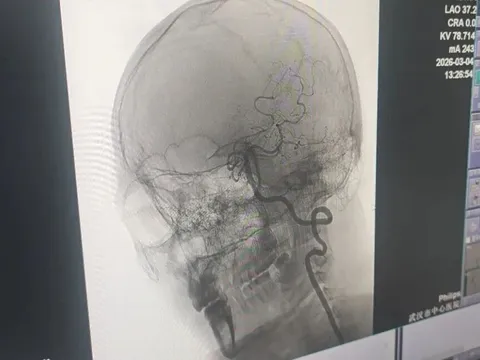 Tưởng xoa bóp vai gáy càng mạnh càng hiệu quả, người đàn ông 33 tuổi bất ngờ bị đột quỵ và liệt nửa người