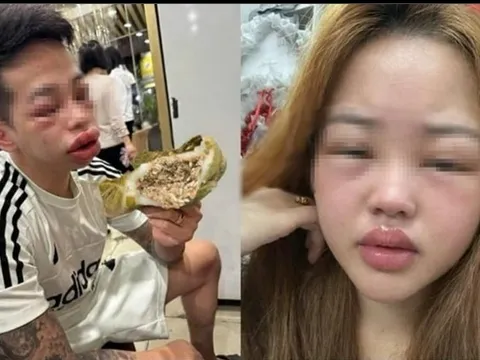 Mặt sưng vù, mắt híp tịt sau khi "đu trend" ăn bánh trứng kiến: Bác sĩ cảnh báo điều này
