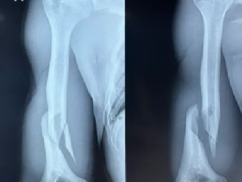 Thanh niên 19 tuổi gãy xương cánh tay vì vật tay