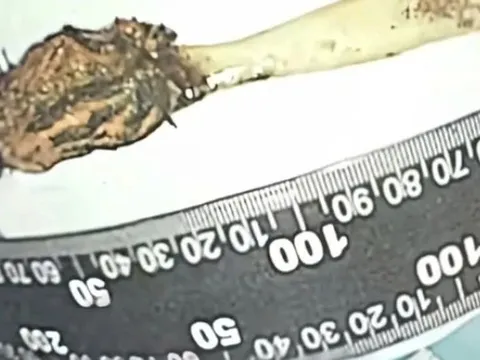 Bí ẩn trong bụng người đàn ông suốt hơn nửa thế kỷ: Một chiếc bàn chải đánh răng