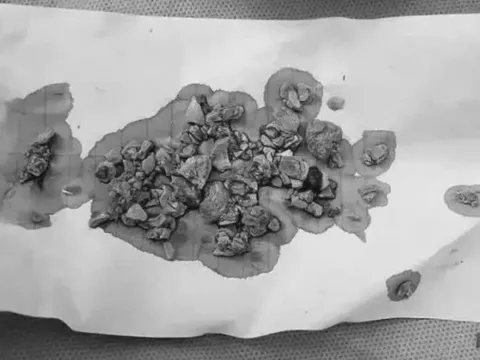 Bé gái 5 tháng bụng chứa đầy sỏi, bác sĩ bàng hoàng khi biết nguyên nhân từ cha mẹ