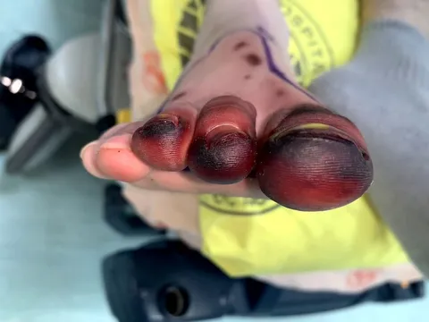 Sơ suất nhỏ khi đi du lịch, người phụ nữ phải đối mặt với nguy cơ mất chân