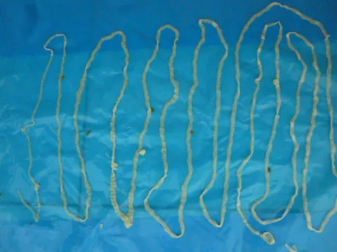 Tưởng rối loạn tiêu hóa, ai ngờ mang sán dây 3 mét "tru ngụ" trong bụng suốt năm trời