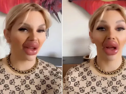 Cô gái chi hơn 175.000 USD để bơm môi, không thể khép miệng vì nghiện thẩm mỹ