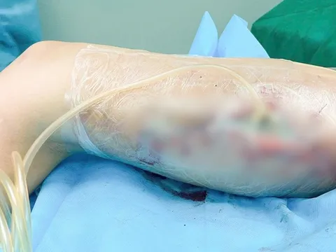 Ham làm đẹp cấp tốc bằng filler không rõ nguồn gốc, cô gái trẻ phải trải qua 60 ca mổ vì hoại tử đùi nặng